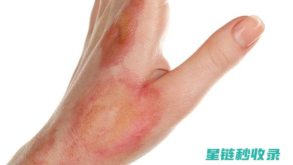 轻微烫伤：第一时间的急救与护理要点 (轻微烫伤第二天是黑色)
